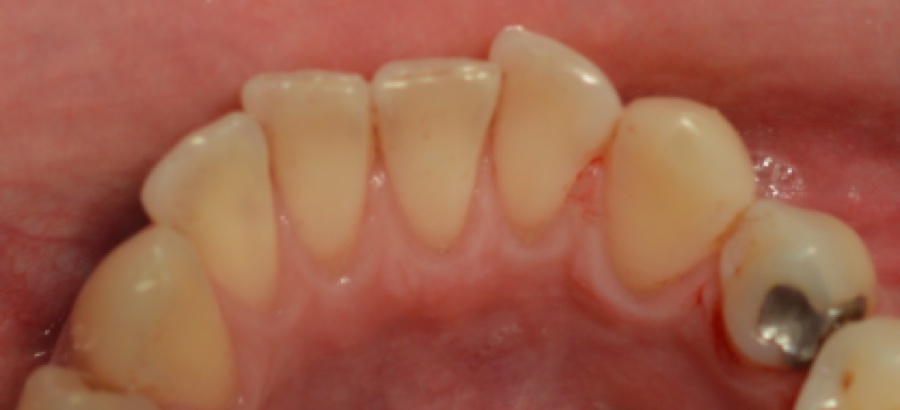Dents après détartrage