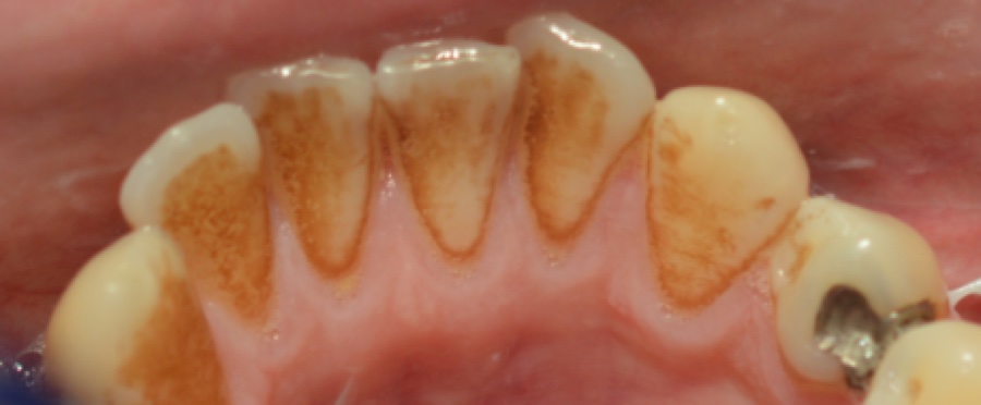 Dents avant détartrage