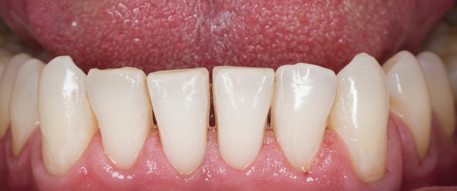 Dents après détartrage