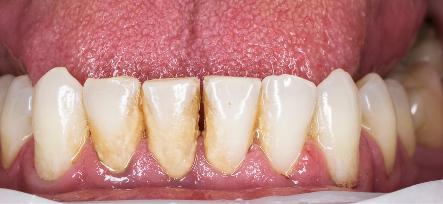 Dents avant détartrage