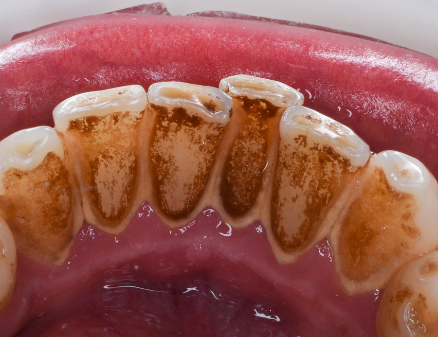 Dents avant détartrage et polissage