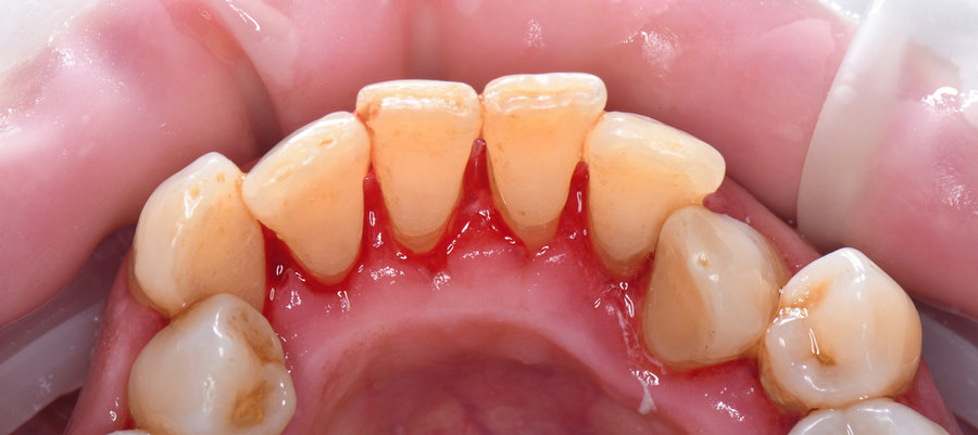 Dents après détartrage
