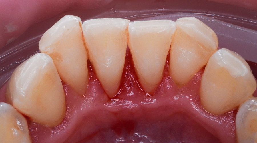 Dents après détartrage