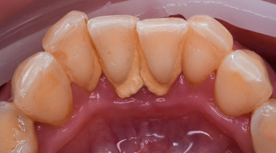 Dents avant détartrage