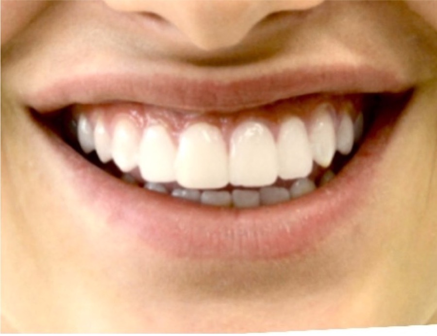 Après facettes dentaires — sourire harmonisé, patiente du cabinet Clear Smile