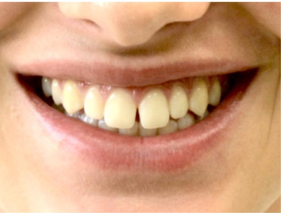Avant facettes dentaires, patiente du cabinet Clear Smile