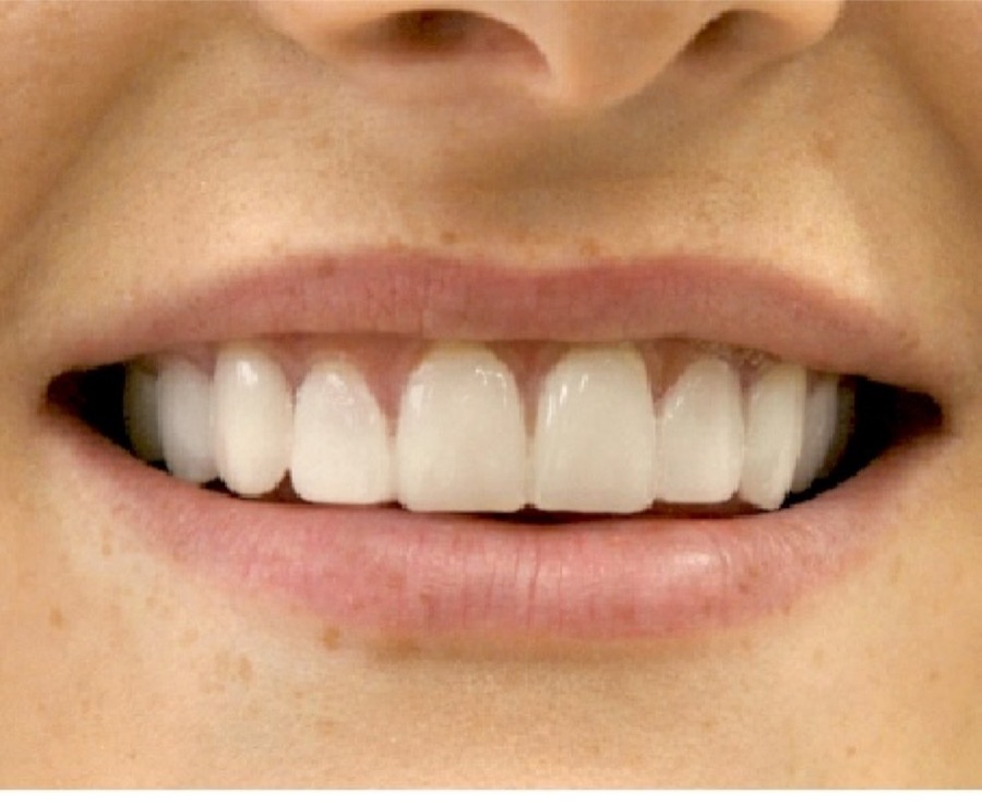 Après facettes dentaires — sourire harmonisé, patient·e du cabinet Clear Smile