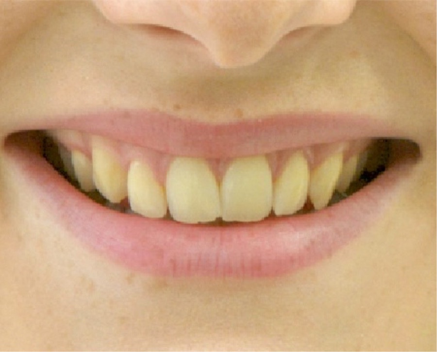 Avant facettes dentaires, patient·e du cabinet Clear Smile