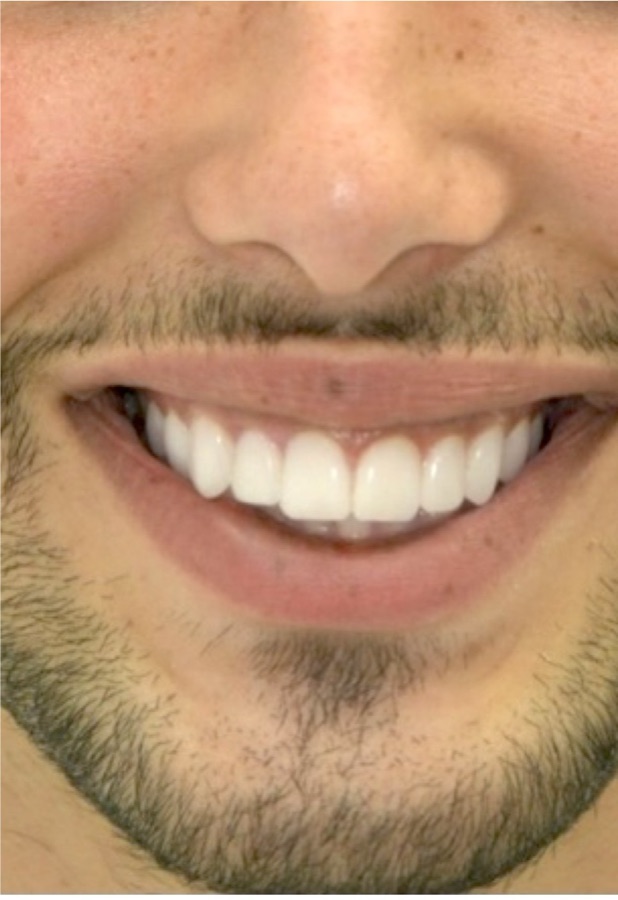 Après facettes dentaires — sourire harmonisé, patient du cabinet Clear Smile
