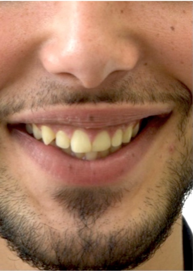 Avant facettes dentaires, patient du cabinet Clear Smile
