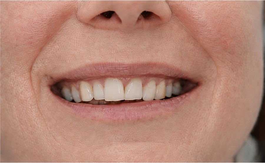 Sourire d'Anne B. après son traitement d'orthodontie invisible chez Clear Smile