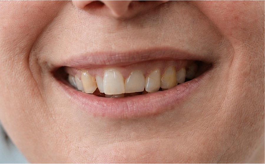 Sourire d'Anne B. avant son traitement d'orthodontie invisible chez Clear Smile