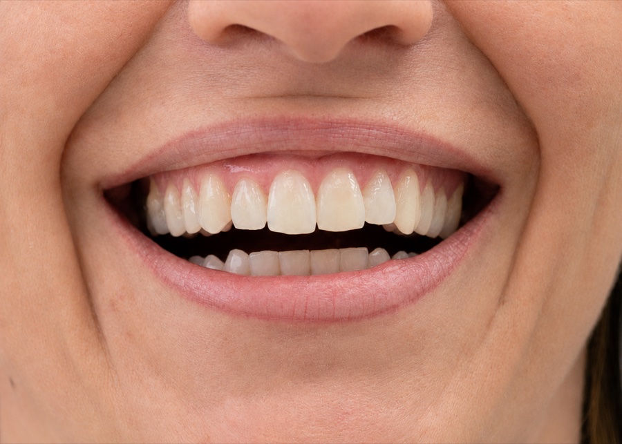 Sourire de Marie R. après son traitement d'orthodontie invisible chez Clear Smile