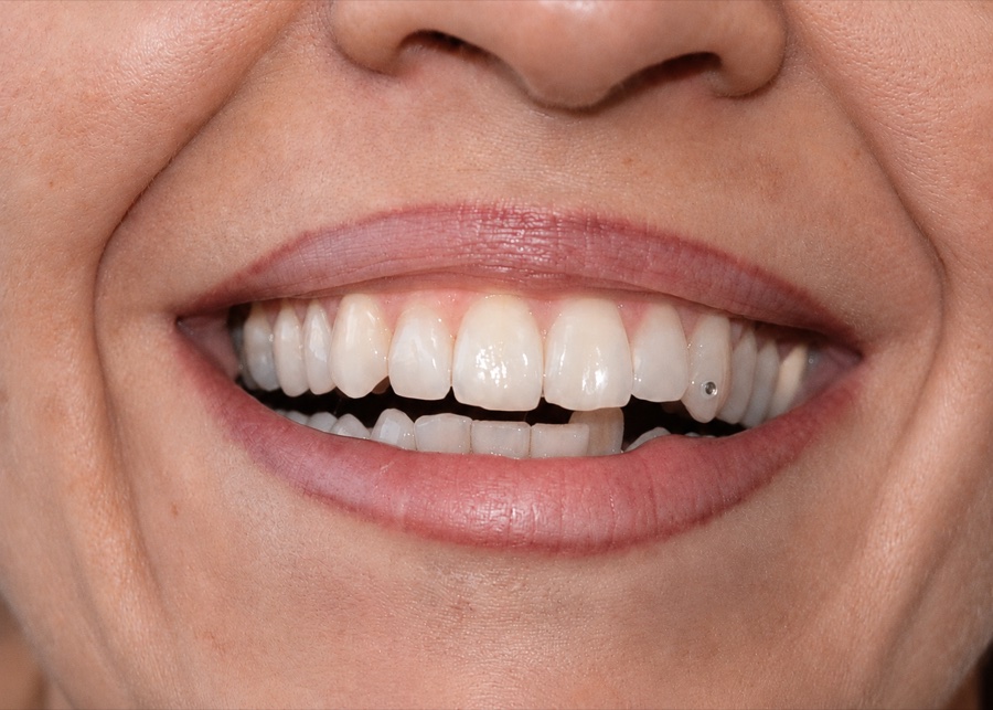 Sourire de Marie R. avant son traitement d'orthodontie invisible chez Clear Smile