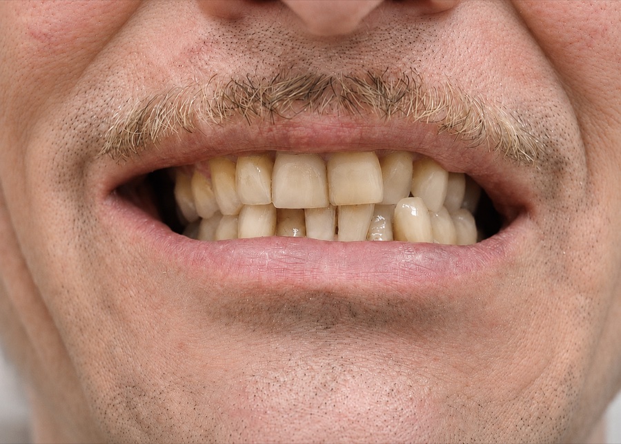Sourire de Philippe C. avant son traitement d'orthodontie invisible chez Clear Smile