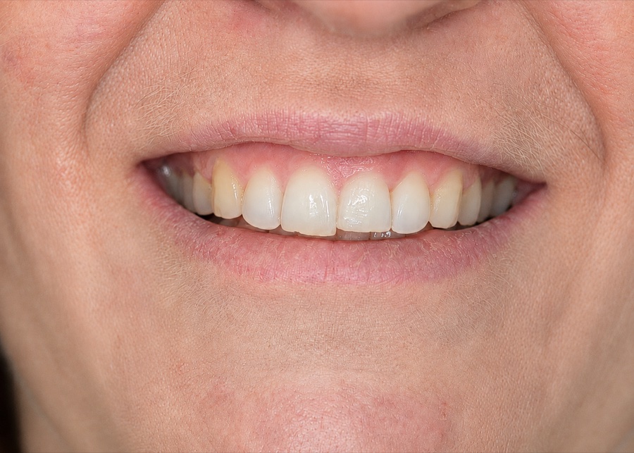Sourire de Stephanie M. après son traitement d'orthodontie invisible chez Clear Smile