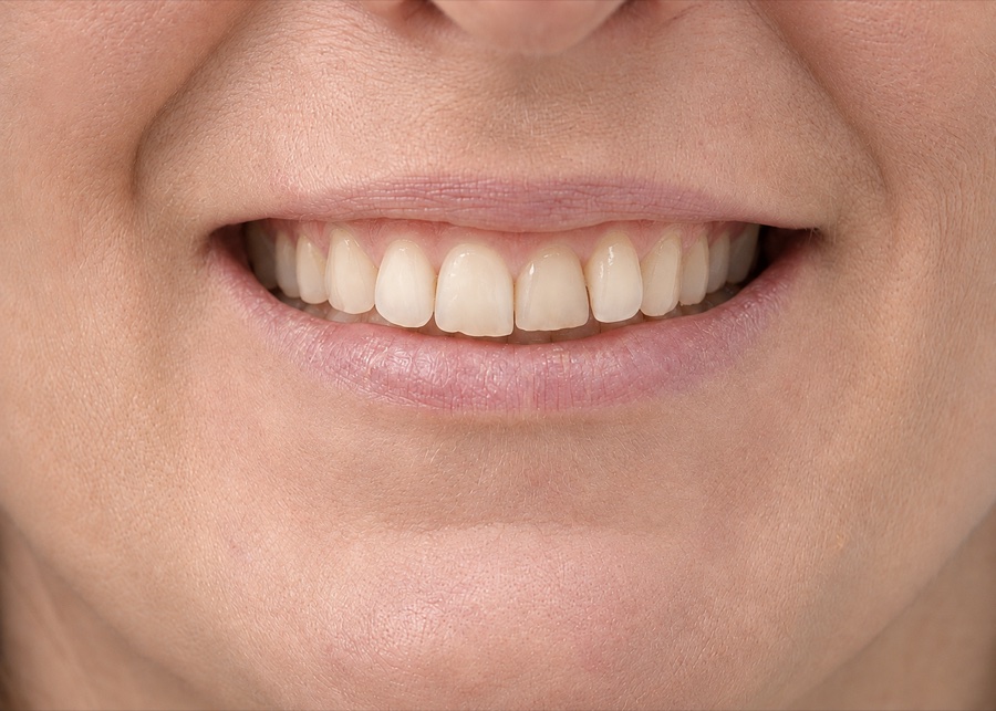 Sourire de Stephanie M. avant son traitement d'orthodontie invisible chez Clear Smile