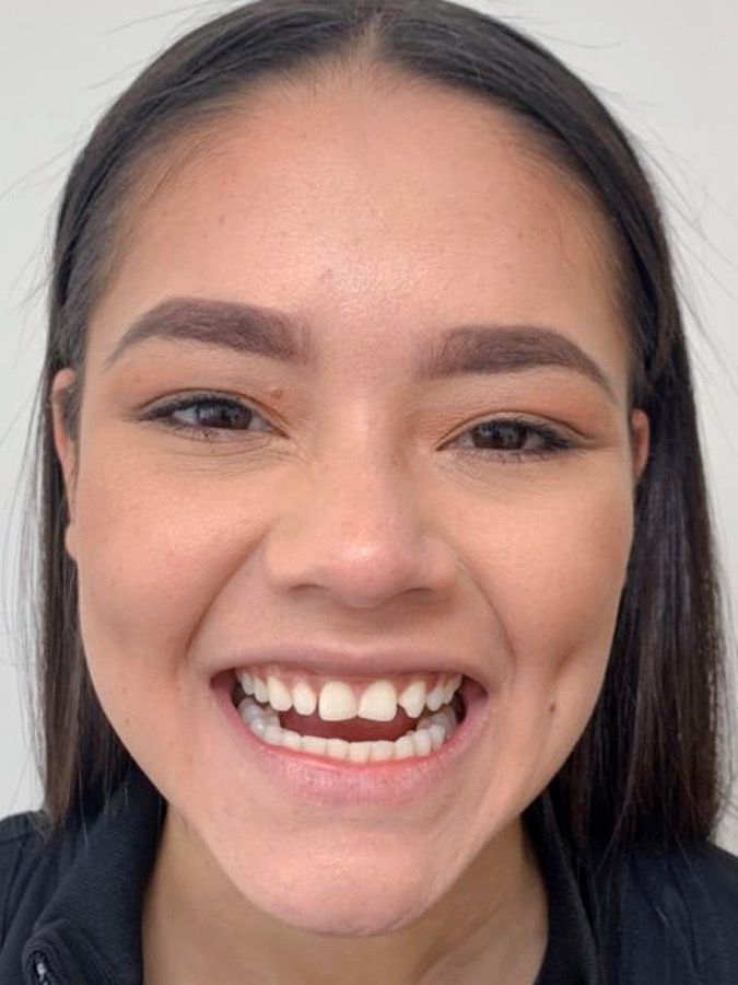 Exemple de sourire trop forcé et exagéré